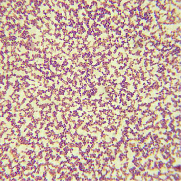 Clinical Presentations and Nosocomial Infections of Neurolisteriosis.