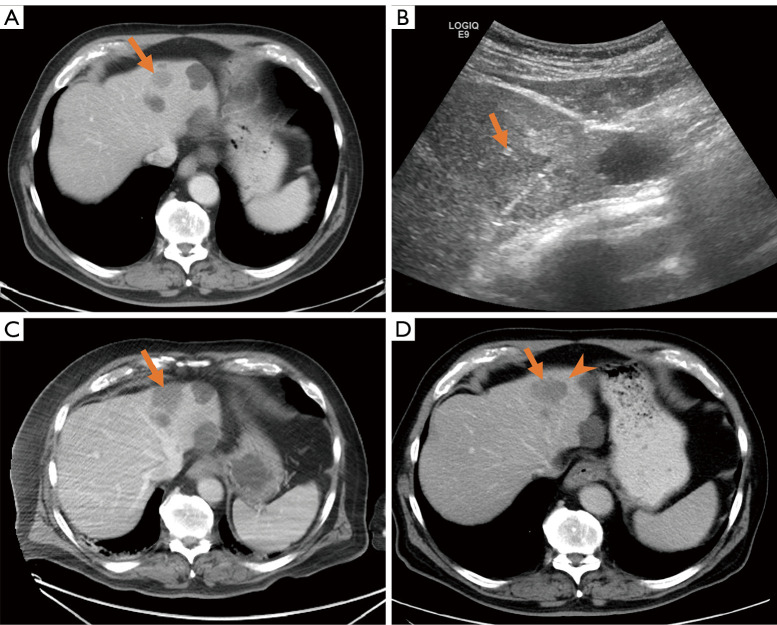 Safety and efficacy of thermal ablation for small cell lung cancer liver metastases.