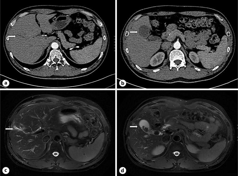 Calculus Cholecystitis Complicated with Variations of Extrahepatic Bile Duct: Clinical Experience and Aeromedical Analysis of 3 Cases in Aviation Pilots.