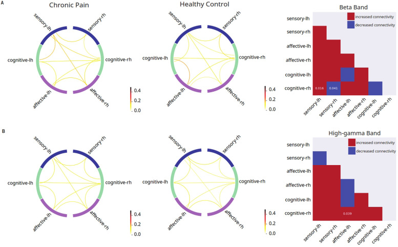 Disruptions in cortical circuit connectivity distinguish widespread hyperalgesia from localized pain.