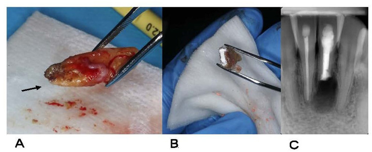 Case Report: Apical periodontitis due to calculus-like deposit on the external surface of the root apex.