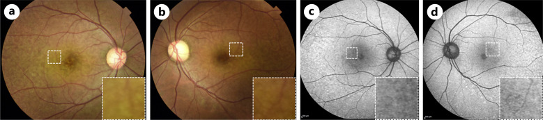 Morphological Changes in the Saw-Tooth Pattern of Cuticular Drusen Associated with Immune Complex-Mediated Membranous Proliferative Glomerulonephritis Type III: A Case Report.