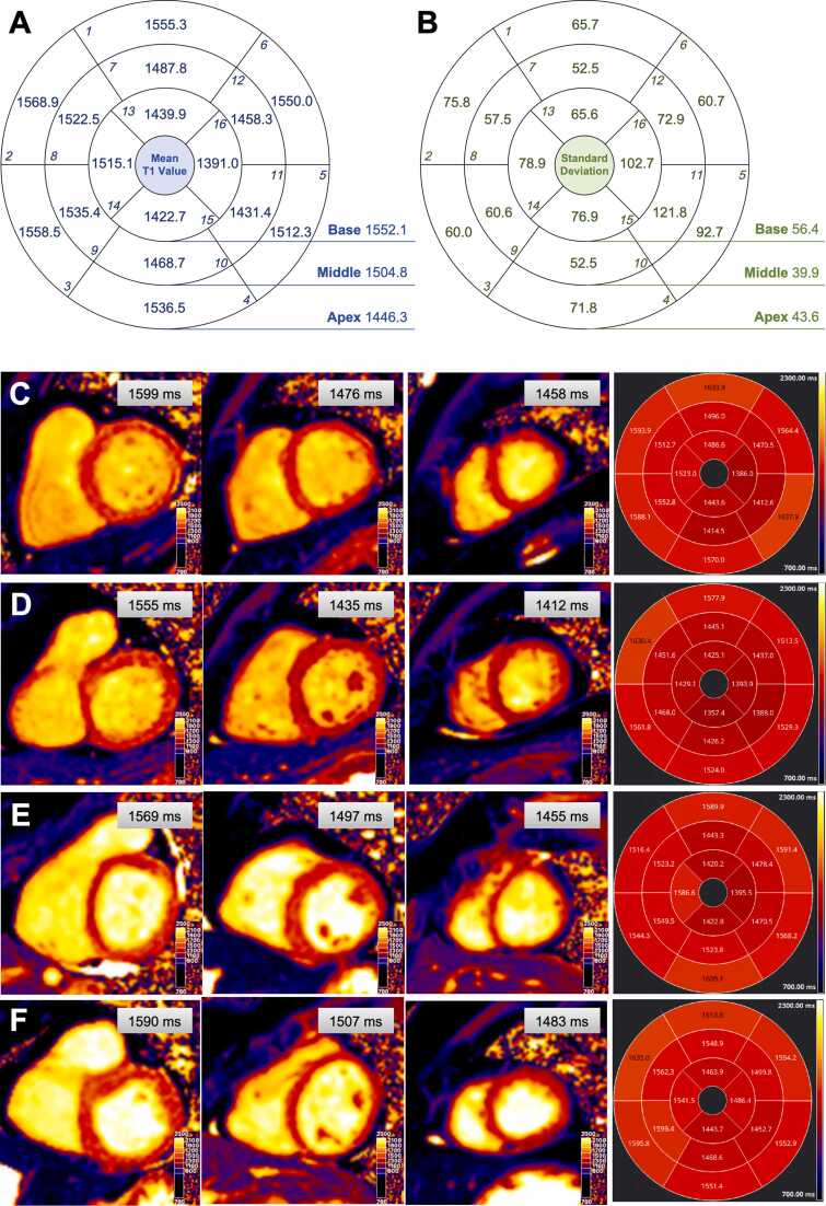 Myocardial native T1 and extracellular volume measurements at 5T: Feasibility study and initial experience.