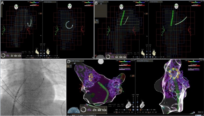 Near-zero fluoroscopy workflow for pulmonary vein isolation in atrial fibrillation using a variable loop, 3D-integrated circular PFA catheter (Varipulse™): initial single-center experience with the first 35 patients.