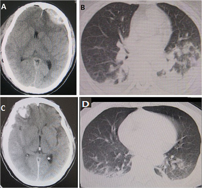 Sepsis in patients with severe TBI: a retrospective CT scoring study.