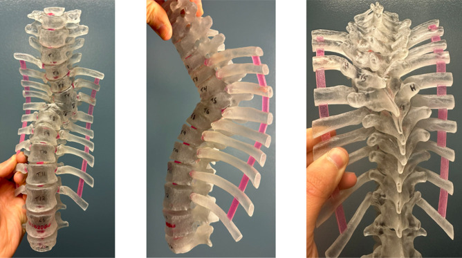 Surgical Sagittal Correction of Symptomatic Sweeping Thoracolumbar Lordosis in an Adolescent With Congenital Kyphoscoliosis.