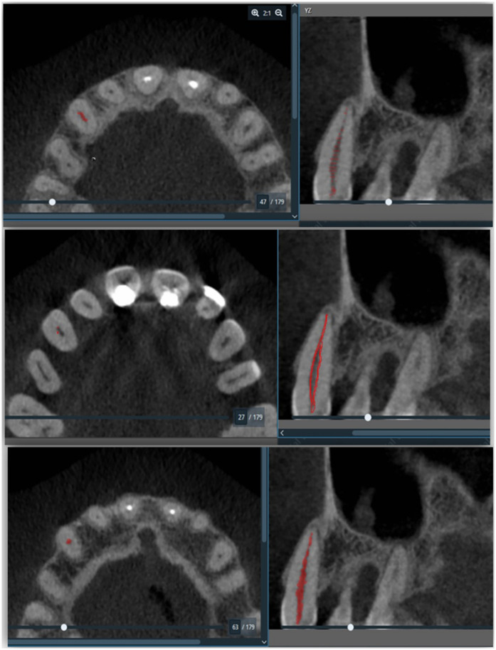 Assessment of pulpal changes in periodontitis patients using CBCT: a volumetric analysis.