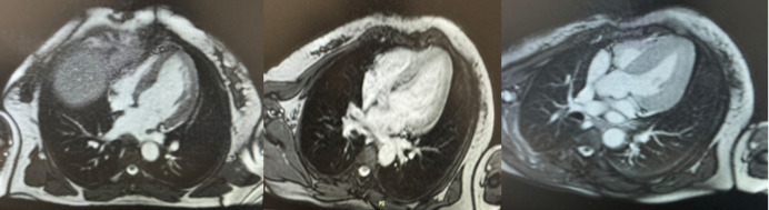 Takotsubo cardiomyopathy due to a pheochromocytoma: a case report.