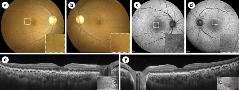 Morphological Changes in the Saw-Tooth Pattern of Cuticular Drusen Associated with Immune Complex-Mediated Membranous Proliferative Glomerulonephritis Type III: A Case Report.