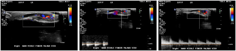 Intravascular papillary endothelial hyperplasia (Masson's tumor) of the finger: a case report and review of the literature.
