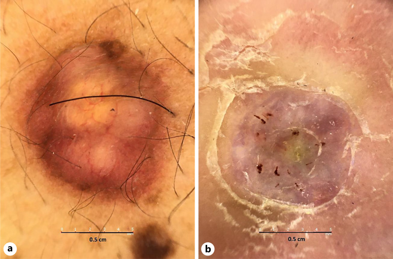 Cutaneous Rosai-Dorfman Disease: A Report of 2 Cases and a Review of Recent Literature (2018-2023).