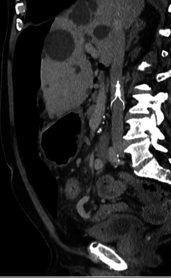 A structured protocol for Preoperative Progressive Pneumoperitoneum (PPP) in Complex Abdominal Wall Reconstruction (CAWR): our York protocol.