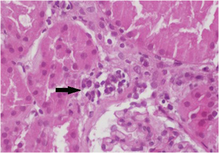The role of peritubular capillaritis in severity of lupus nephritis.