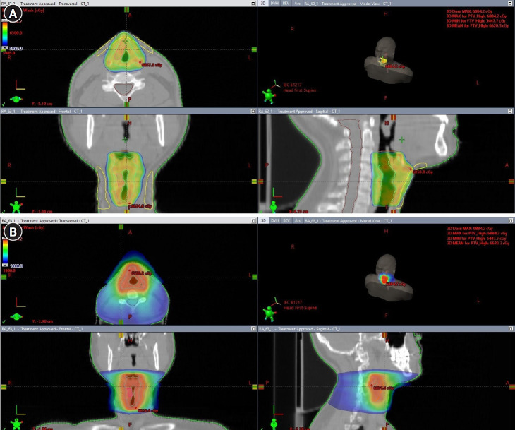 An isoradiotopic response of lichen planus: a case report and review of literature.