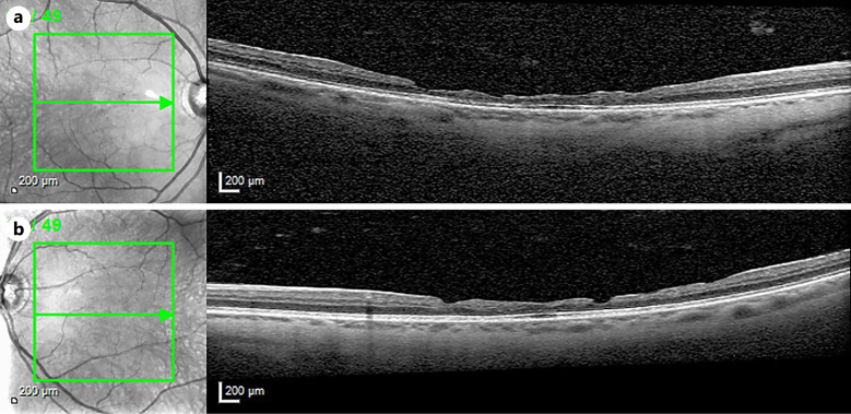 Stair-Case/Honeycomb Maculopathy in Alport Syndrome: A Case Report.
