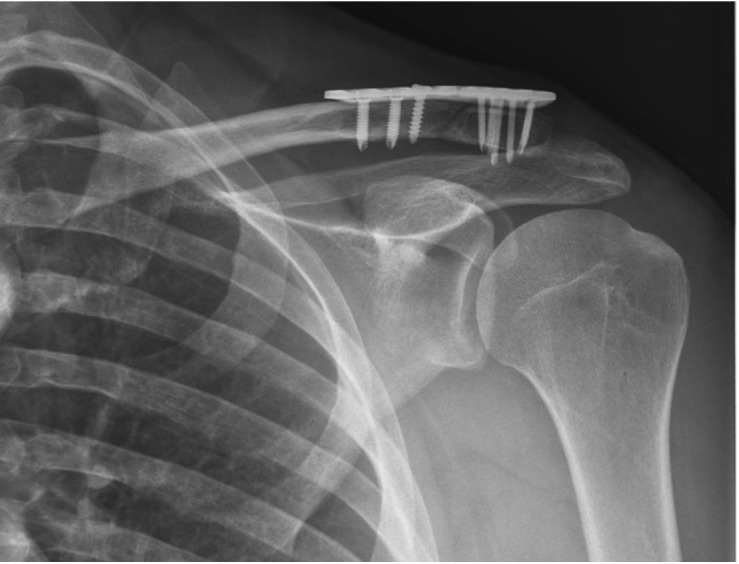 Importance of suture Endobutton augmentation in type 2B clavicle fracture fixation using a locking plate.