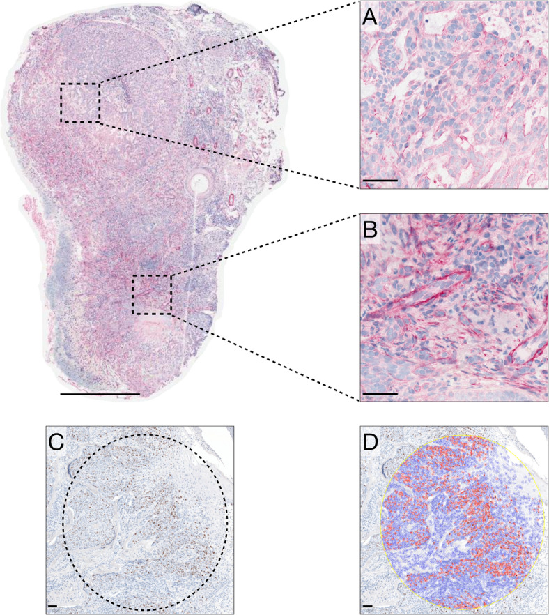 Immunohistochemical expression of smoothened in periocular basal cell, squamous cell and sebaceous carcinomas.