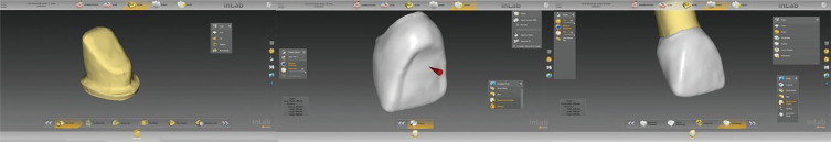 Effect of thermomechanical aging on fracture strength of anterior crowns fabricated with different CAD-CAM materials.