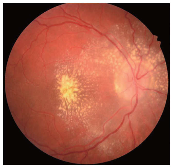Clinical Characteristics and Visual Outcomes of Cat Scratch Disease.