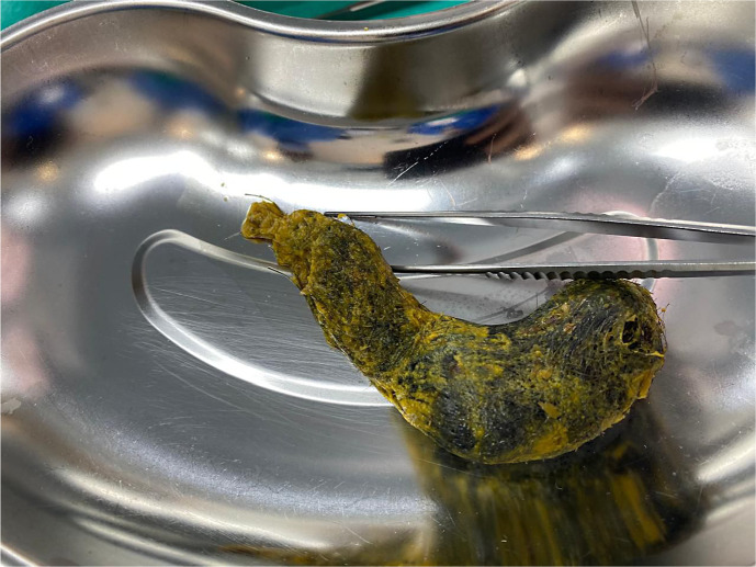 Beyond Inflammatory Bowel Disease: Calprotectin as a Marker for Trichobezoar? A Case Report.
