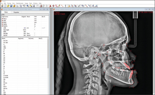Assessment of condylar and glenoid fossa dimension in various sagittal skeletal malocclusions.