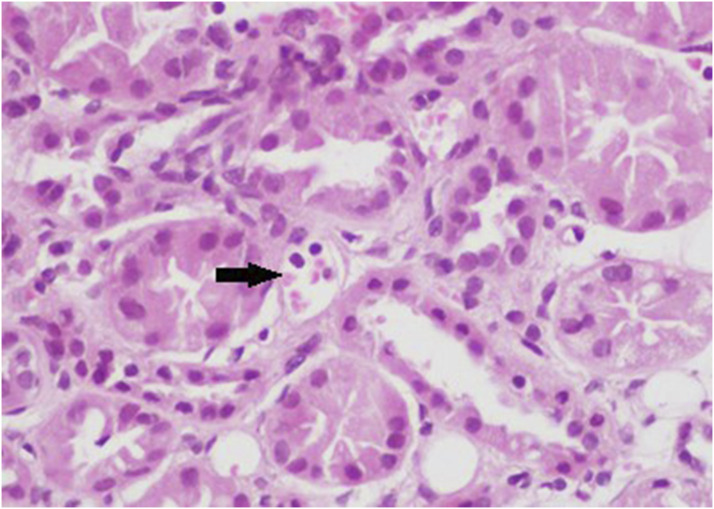 The role of peritubular capillaritis in severity of lupus nephritis.