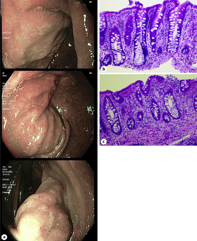 Gastroduodenal Strongyloidiasis Diagnosed during Iron Deficiency Anemia Workup.