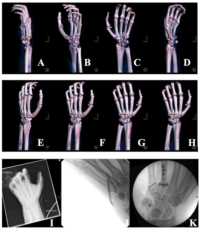 Explosion-Related Polytrauma from Illicit Pyrotechnics: Two Case Reports and a Public Health Perspective.