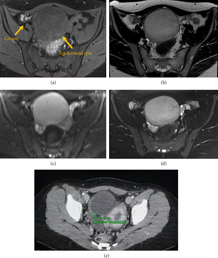 Epidermoid Cyst of the Cecum Treated by Laparoscopic Colectomy: A Case Report With Histopathology and Literature Review.