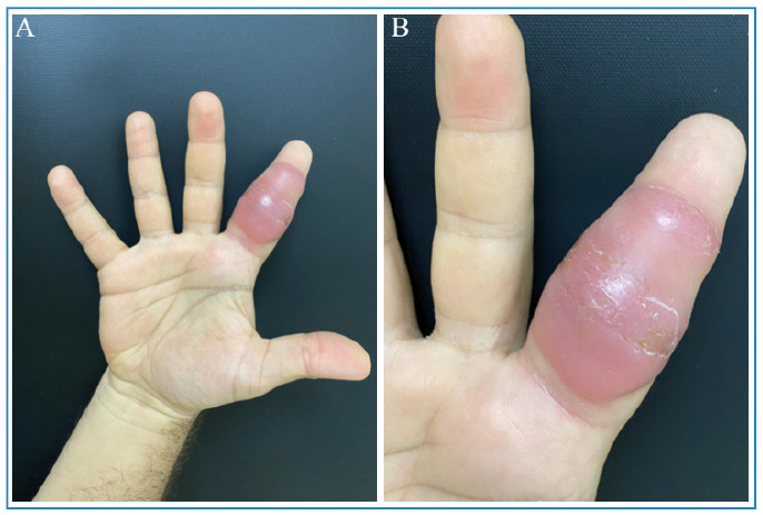 Cutaneous nontuberculous mycobacterial infection after intra-articular corticosteroid injection in a patient with psoriatic dactylitis.