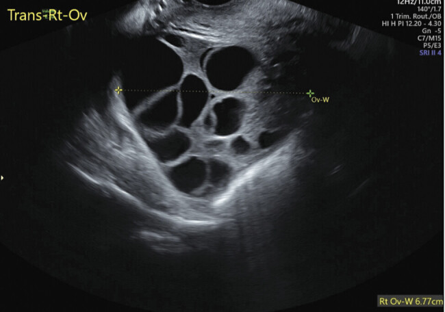 Thyroid Storm Triggered by Partial Hydatidiform Mole: A Rare and Life-Threatening Complication.