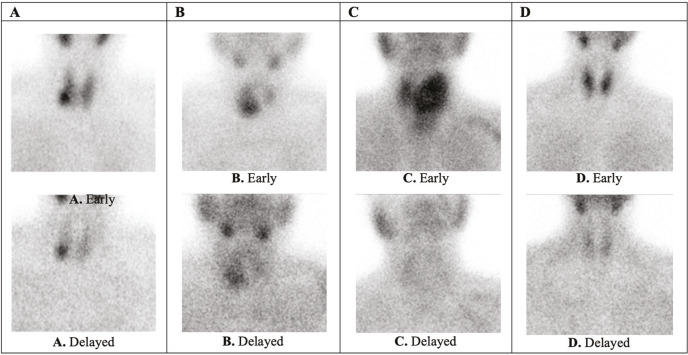 A Comprehensive Diagnostic Assessment of Thyroid Nodules Utilizing Scintigraphy and Telomere Lengths (T/S ratios).