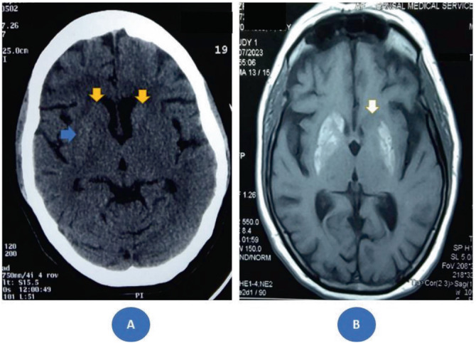 Ipsilateral diabetic striatopathy: A case of clinicoradiological discordance and evolving movement disorders.