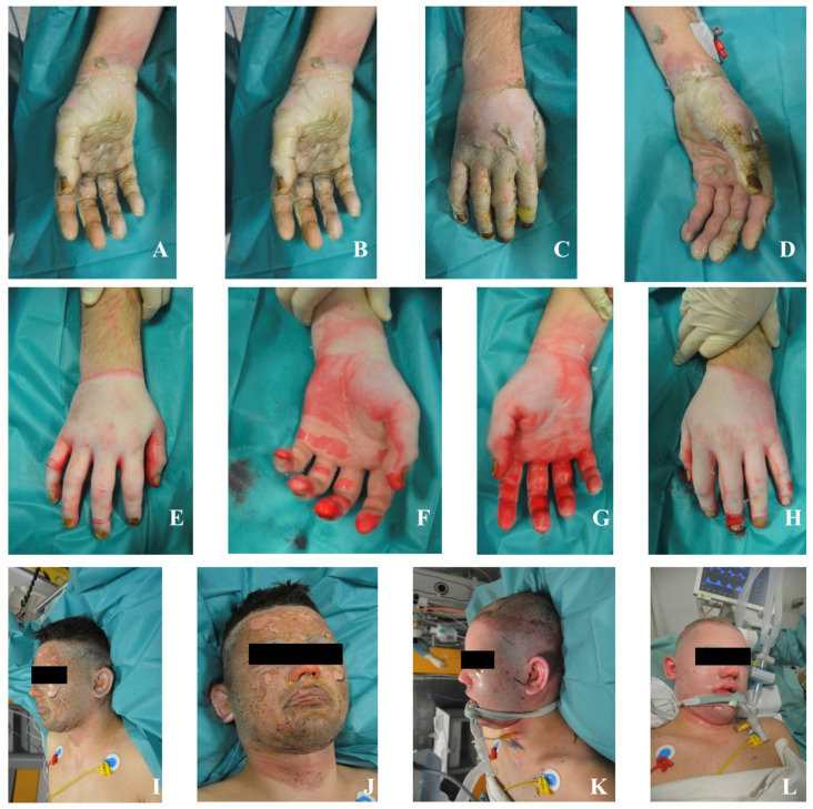 Explosion-Related Polytrauma from Illicit Pyrotechnics: Two Case Reports and a Public Health Perspective.
