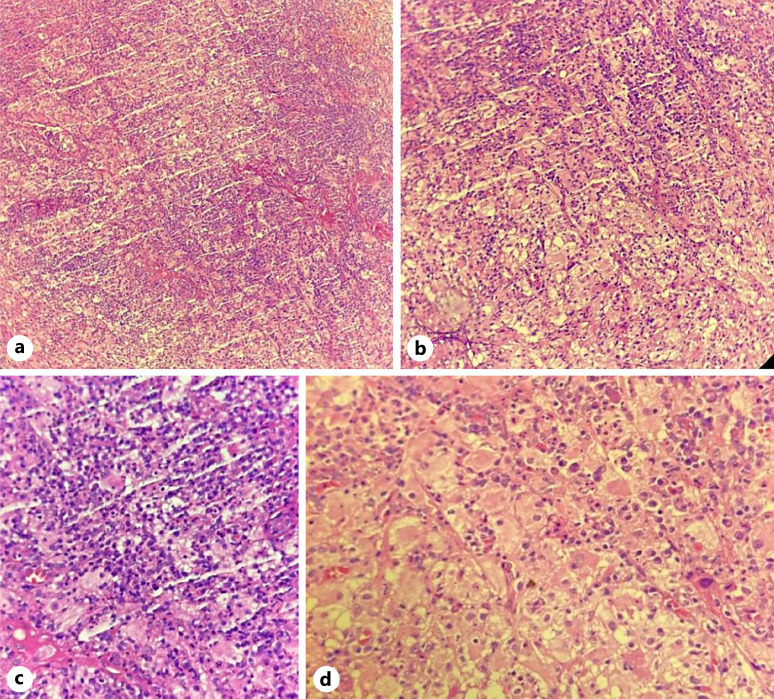 Cutaneous Rosai-Dorfman Disease: A Report of 2 Cases and a Review of Recent Literature (2018-2023).