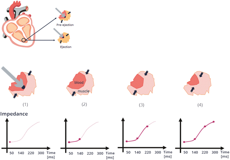 The clinical role of closed loop stimulation pacemakers in the treatment of patients with sinus node dysfunction: a review.