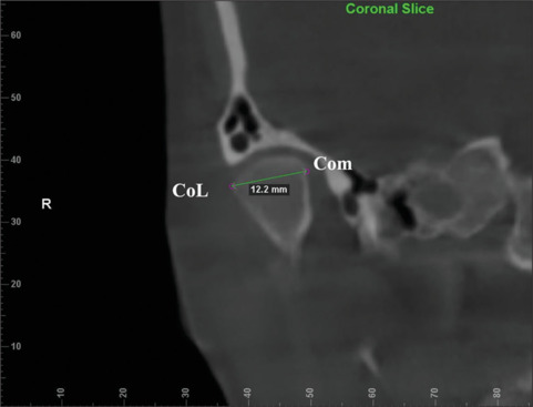 Assessment of condylar and glenoid fossa dimension in various sagittal skeletal malocclusions.