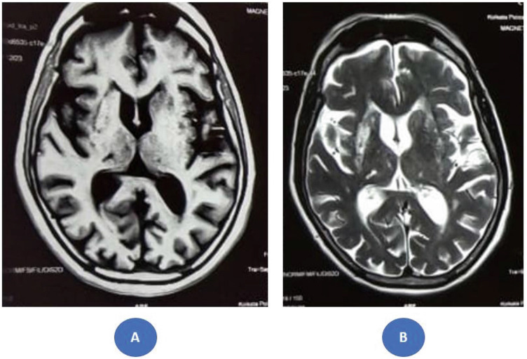 Ipsilateral diabetic striatopathy: A case of clinicoradiological discordance and evolving movement disorders.