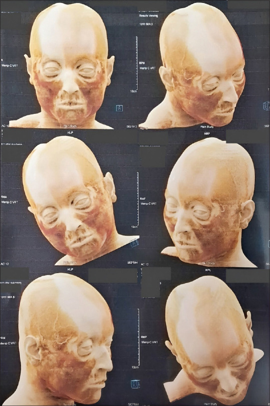 Uveitis in Parry-Romberg syndrome: A case report and review of literature.