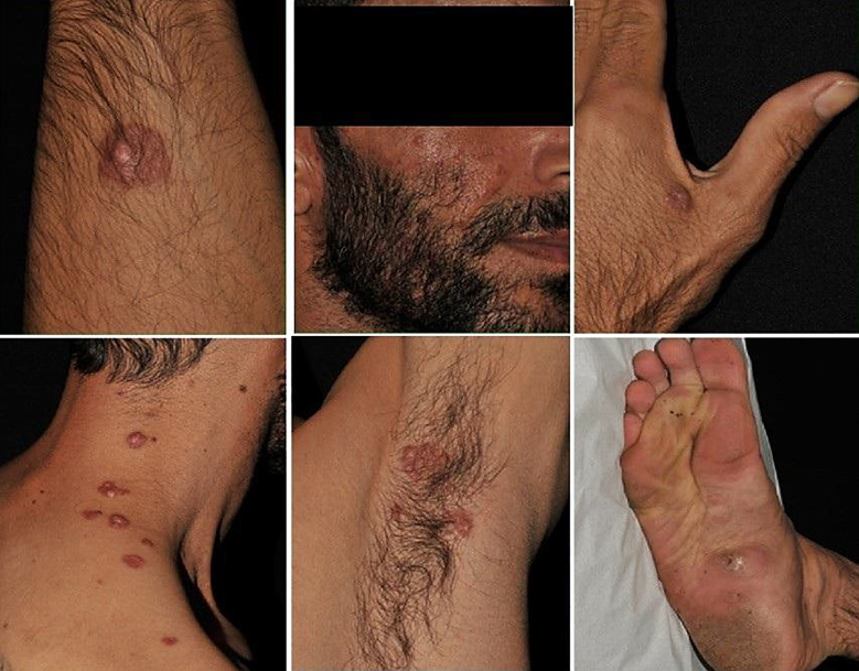 Cutaneous Rosai-Dorfman Disease: A Report of 2 Cases and a Review of Recent Literature (2018-2023).
