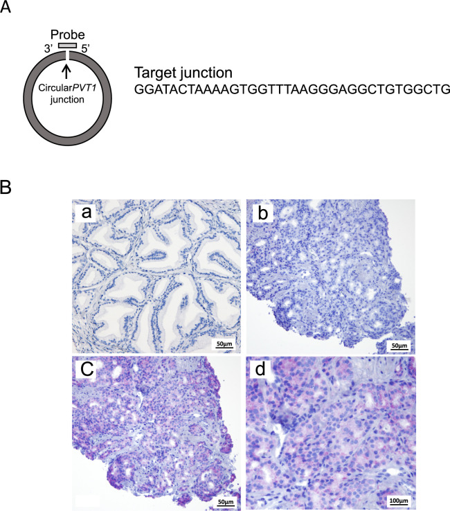 Impact of circ<i>PVT1</i> Expression on Prostate Cancer Malignancy and Tumor Growth.