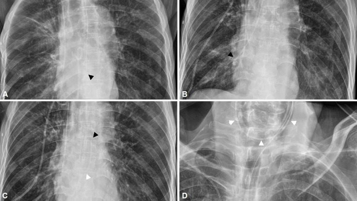 Series of Inadvertent Misplacements of Nasogastric Tube in a Patient.