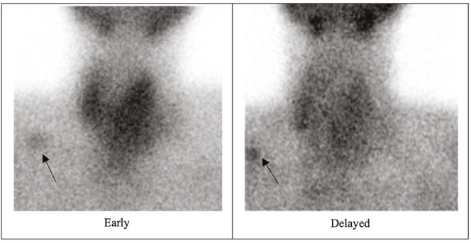 A Comprehensive Diagnostic Assessment of Thyroid Nodules Utilizing Scintigraphy and Telomere Lengths (T/S ratios).