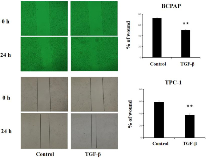 TGF-β induces EMT in thyroid cancer cells by regulating transcription factors.