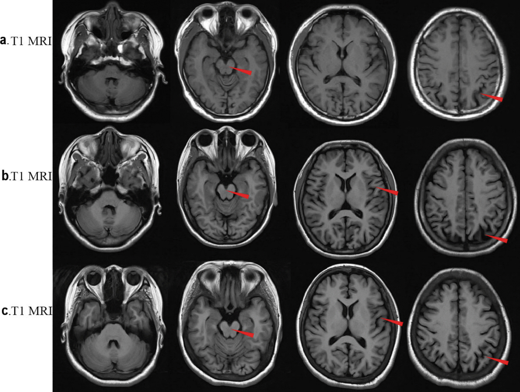 Type I Sialidosis in a Chinese family: a case report and literature review.