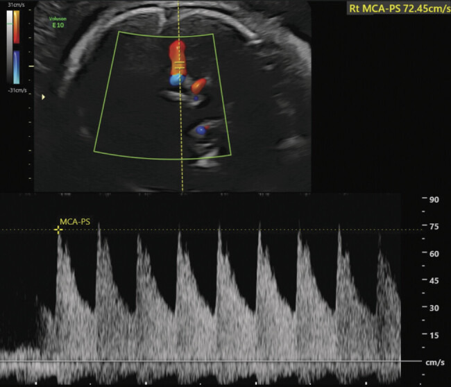 Fetal Cytomegalovirus Associated Intraventricular Hemorrhage: A Rare Prenatal Complication.