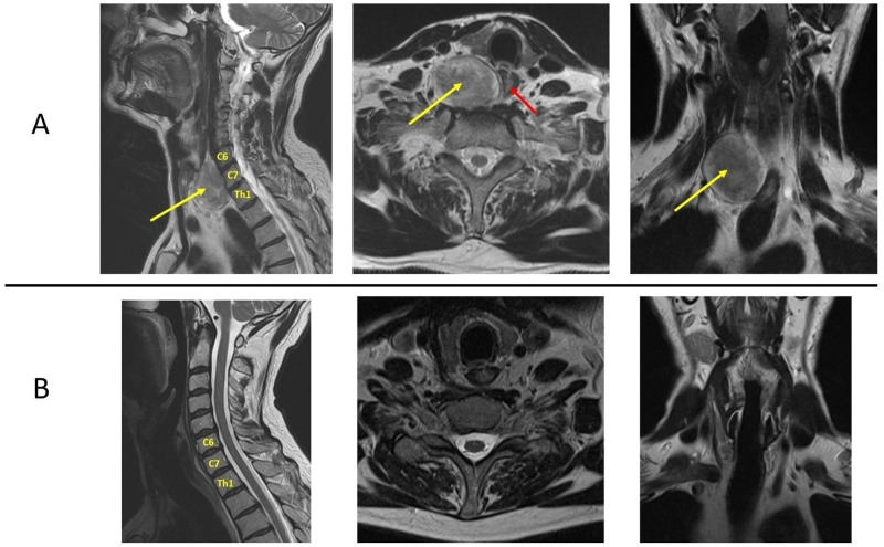 Large Anterior Cervical Spine Schwannoma Causing Dysphagia: Case Report.