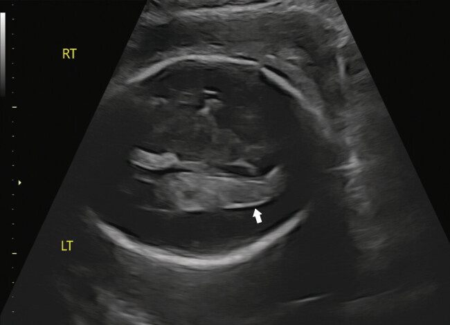 Fetal Cytomegalovirus Associated Intraventricular Hemorrhage: A Rare Prenatal Complication.
