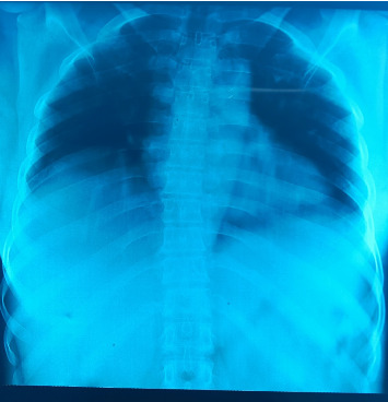 First Cases of Dengue Fever Confirmed in the National Hospitals of Zinder and Niamey.