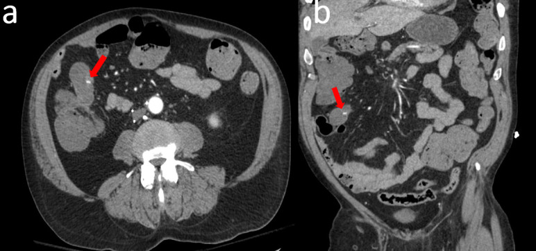 Massive lower gastrointestinal bleeding due to Meckel's diverticulum in an atypical position.